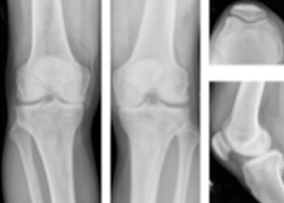 Xray before the surgery