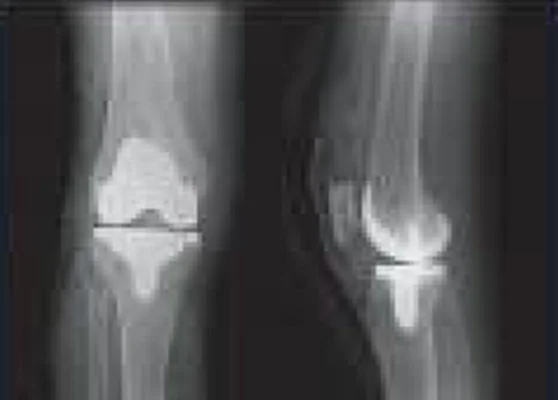 xray or implant Post surgery by LEO2 by Stryker Mako