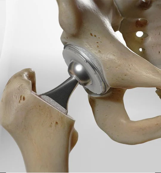Robotic Knee Replacement Surgery
