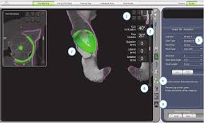 Pre-Operative Planning stage – virtual bone model before Robotic Hip Replacement Surgery