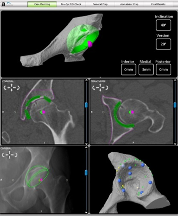 Accurate position is visualized on a screen while Robotic Hip Replacement Surgery