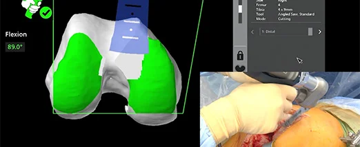 Robotic Arm Assistant for Orthopedic Robotic Surgery